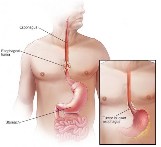 ds00500_hq00312_im03991_c7_esophagealcancerthu_jpg ds00500_hq00312_im03991_c7_esophagealcancerthu_jpg